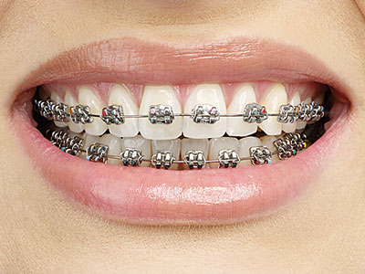 Metallbrackets